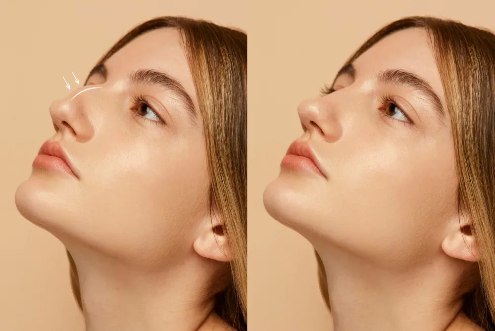 Rinoplastia